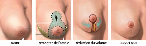 cicatrices réduction mammaire Tunisie