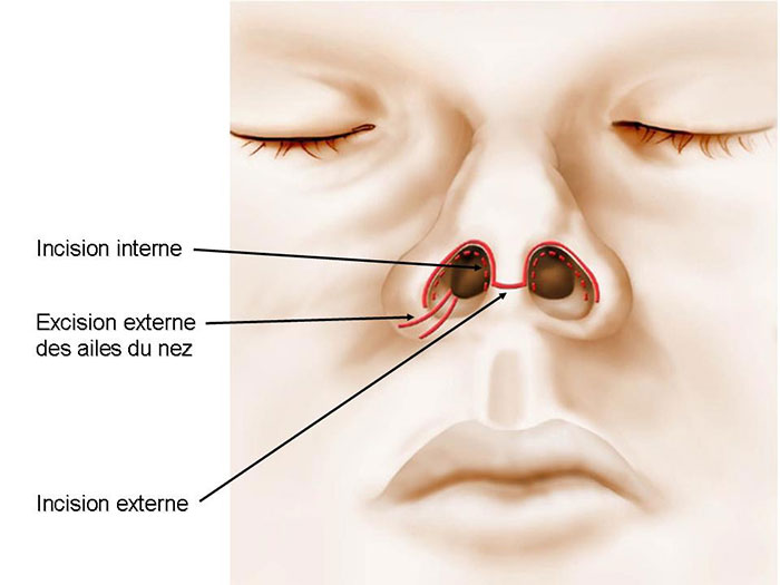 cicatrices rhinoplastie