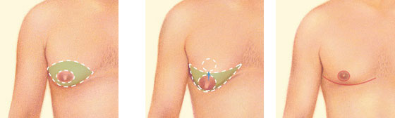 gynecomastie tunisie pas cher