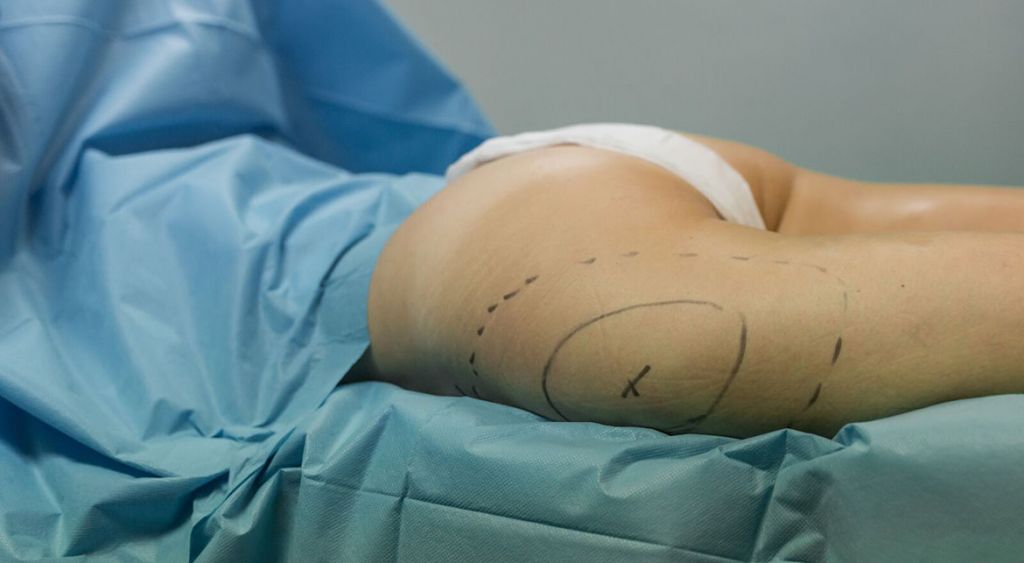 liposuccion hanches Tunisie