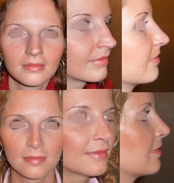 rhinoplastie Tunisie photo avant apres