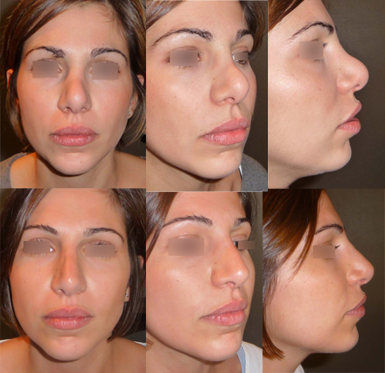 rhinoplastie tunisie avant apres