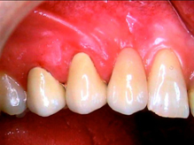   Colocación de una corona dental para aliviar los problemas bucales del paciente.