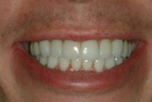  Pose de facettes dentaires adaptées à la forme des dents et à l’état des gencives.