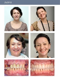   Rehabilitación de dientes con implantes cerámicos y alineación.