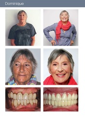  Remplacement des dents manquantes et défectueuses par facettes et implants dentaires.