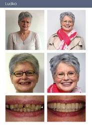   Los implantes dentales pueden darle una sonrisa brillante