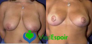 réduction des seins avant apres