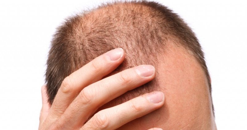 Solutions anti chute de cheveux Solutions anti chute de cheveux