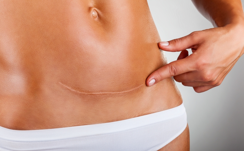 abdominoplastie-tunisie