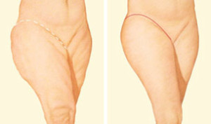 incision vertical lifting cuisses