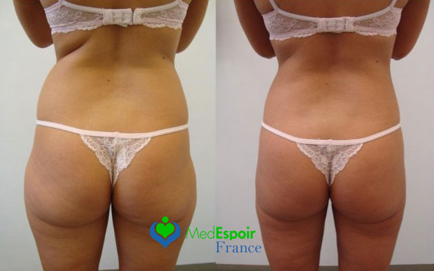 liposuccion hanches Tunisie avant après