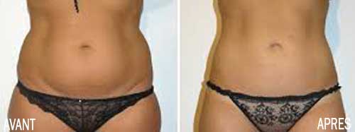 liposucción vientre Túnez antes y después