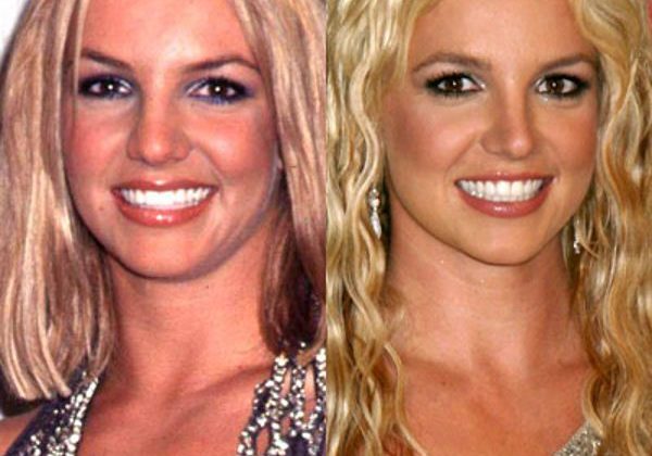 Stars succombées à la rhinoplastie : Avant et Après l’intervention de chirurgie du nez ! Stars succombées à la rhinoplastie : Avant et Après l’intervention de chirurgie du nez !