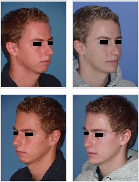Profiloplastia-antes y después
