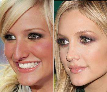 rhinoplastie Ashlee Simpson