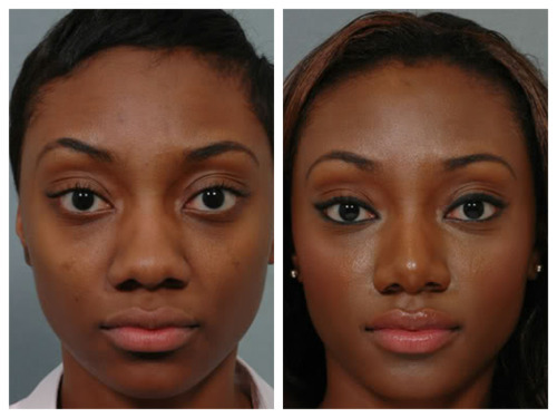 rhinoplastie ethnique Tunisie photo avant apres