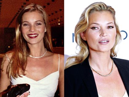 rhinoplastie kate moss