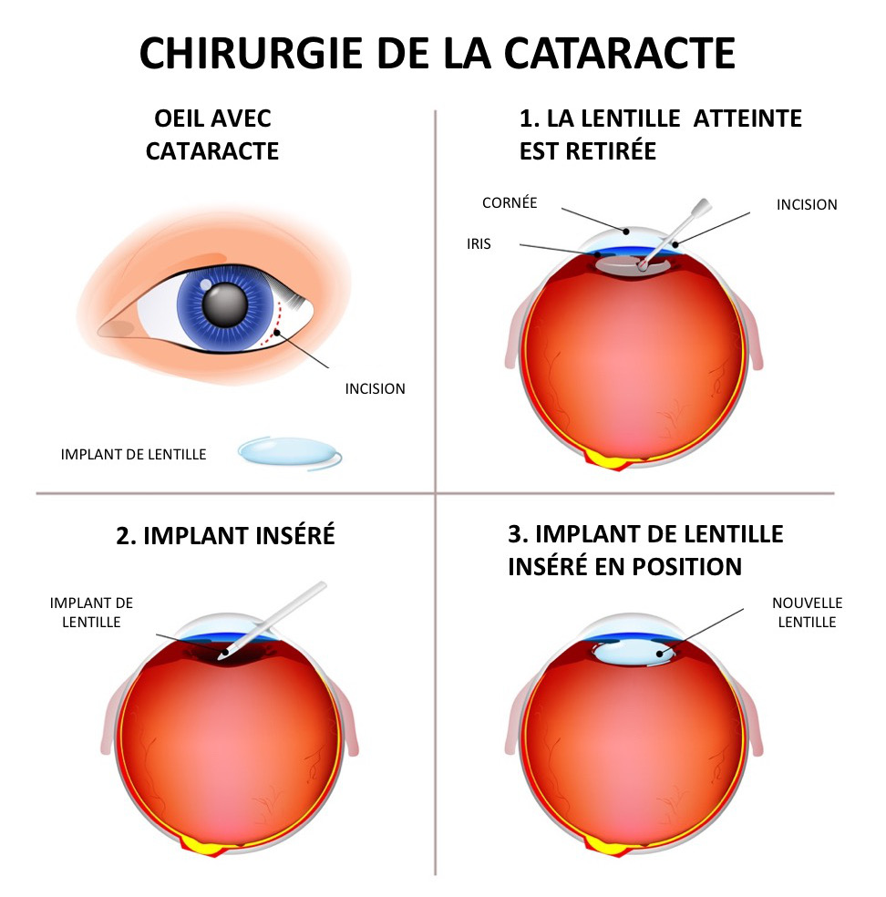 Chirurgie Cataracte Tunisie