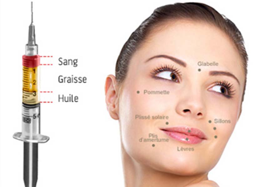 lipofilling traitement rides visage