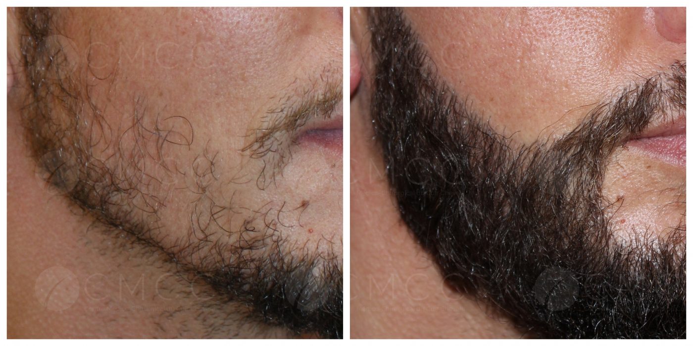 trasplante de barba tunez fotos antes y despues