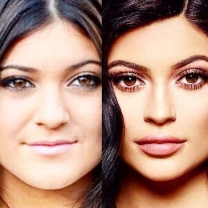 Photo avant après de lèvres de Kylie Jenner