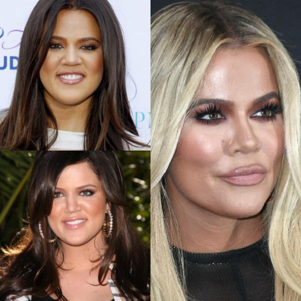Chirurgie-plastique-Khloe-Kardashian-photos-avant-et-apres