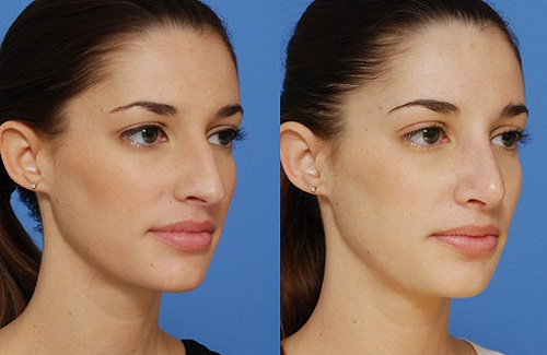 rhinoplastie Turquie avant après
