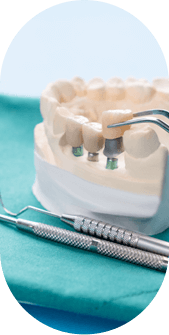 implant dentaire