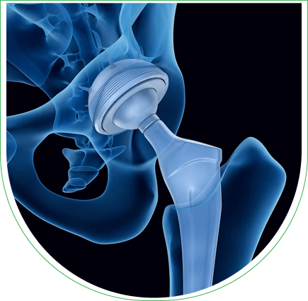 Prótesis de cadera en Túnez: cirugía ortopédica fiable  