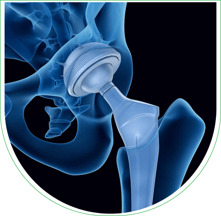Prothèse de la hanche en Tunisie : Chirurgie orthopédique fiable