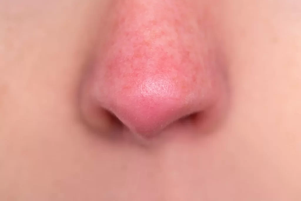 Traitement des veines sur le nez : Différents traitements de la ...