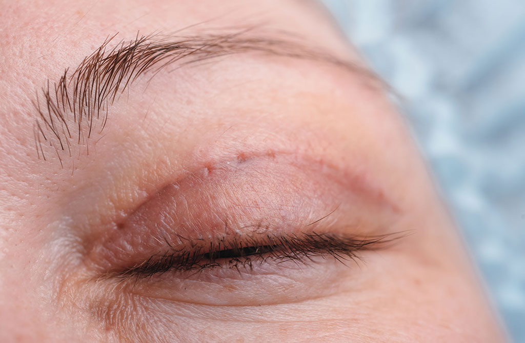 blépharoplastie à Paris