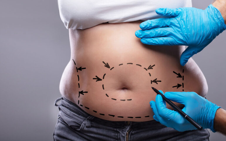 abdominoplastie paris