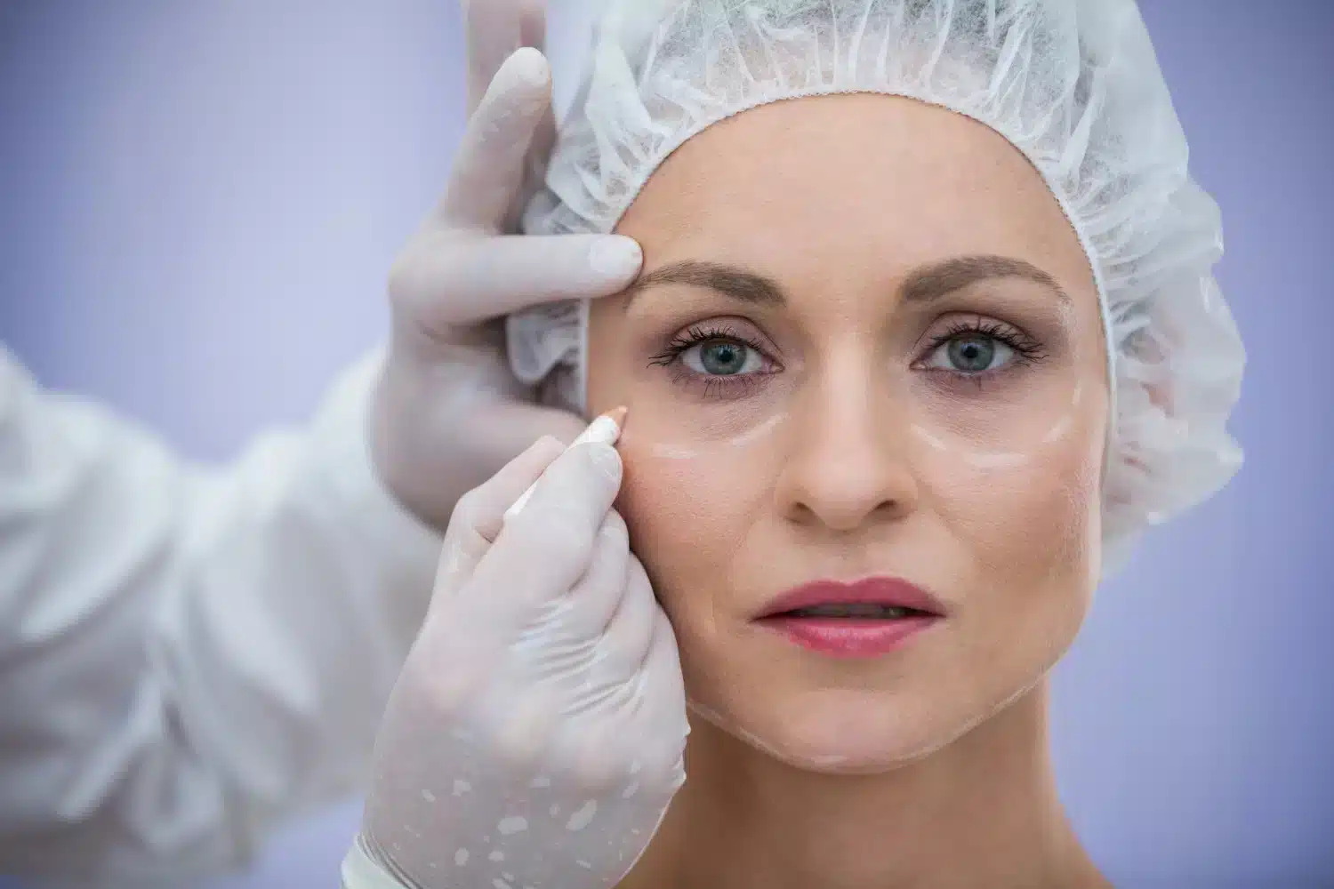 blepharoplastie lyon