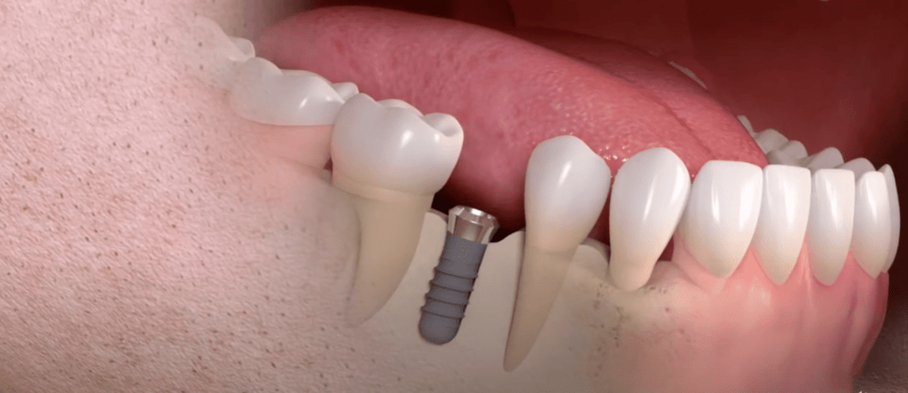 implant dentaire Marseille
