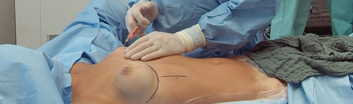Lipofilling mammaire Lyon