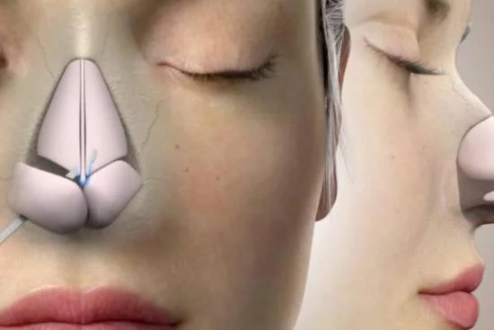 rhinoplastie ultrasonique France