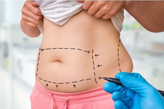 Liposuccion et Redrapage