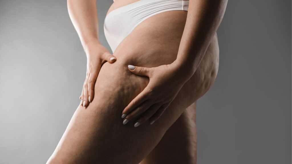 Lip&oelig;d&egrave;me et hormones