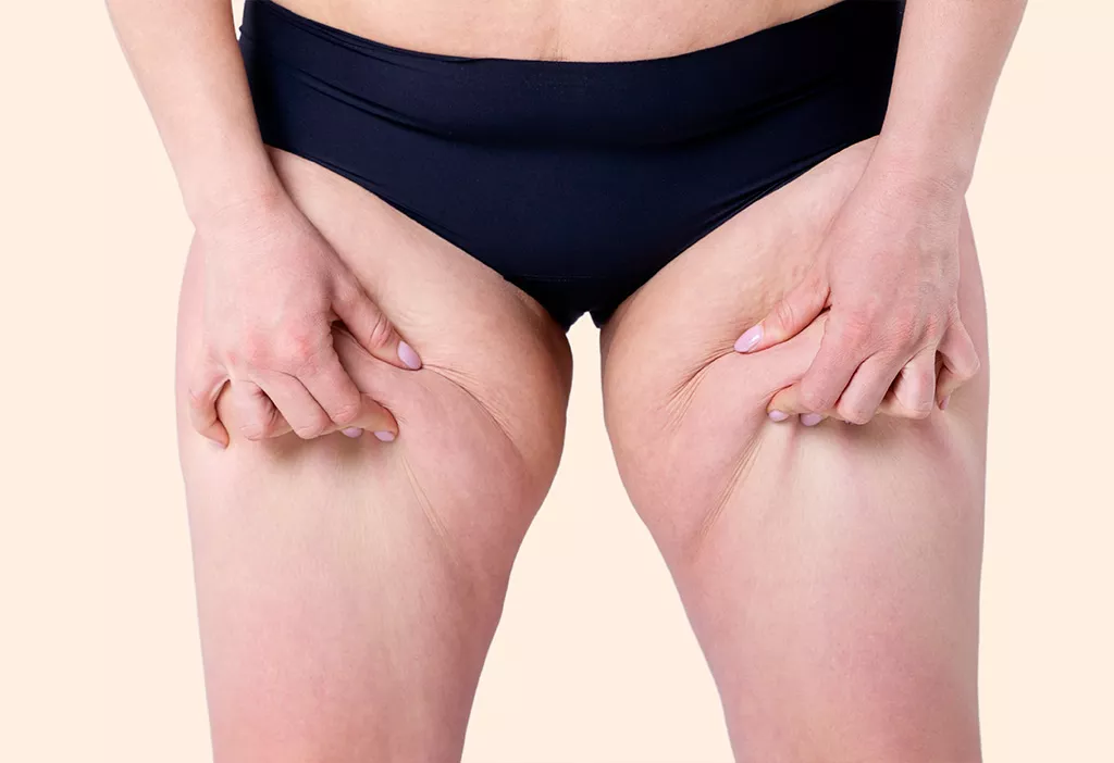 lipoedeme Tunisie les liposuccions ne traitent pas r&eacute;ellement la maladie