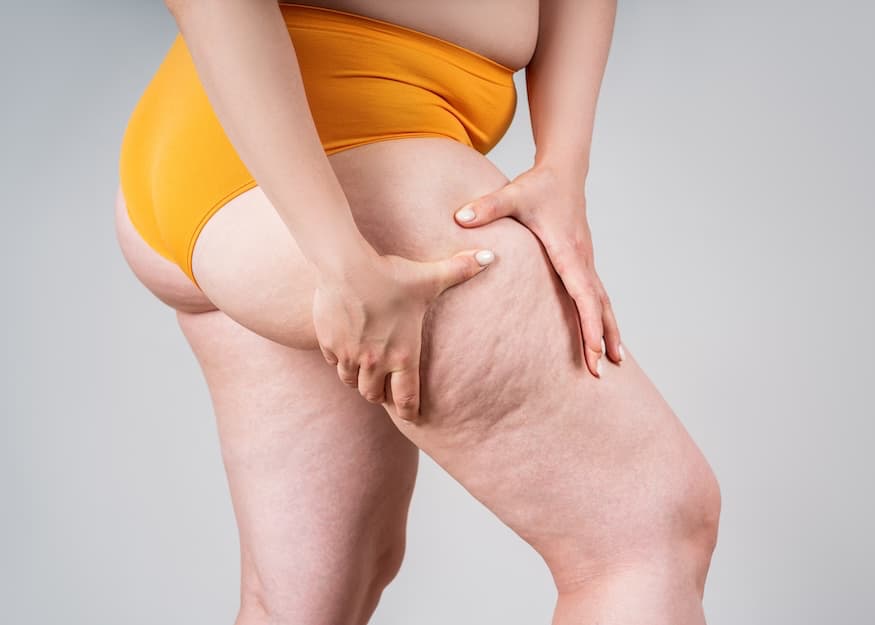 chirurgie lip&oelig;d&egrave;me Tunisie
